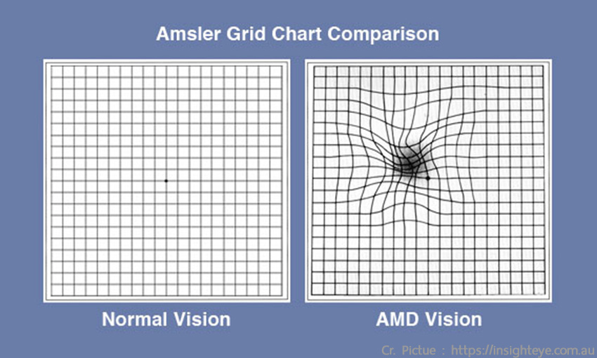 Macular Degeneration Eye Chart Grid