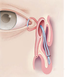 ENDOSCOPIC DCR