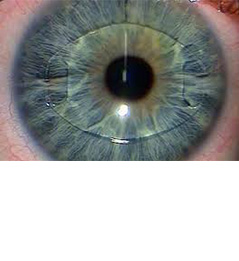 PHAKIC INTRAOCULAR